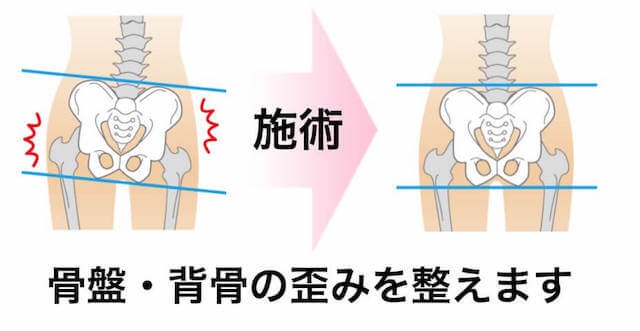 腰痛の根本改善のための施術1