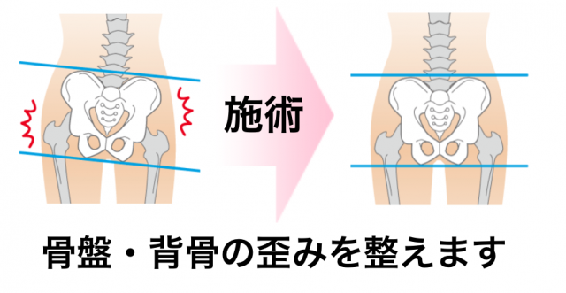 Ｏ脚・Ｘ脚の治療1