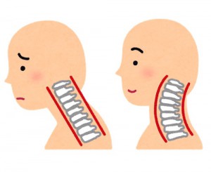 首こりの原因の一つ　ストレートネックと長時間のスマホの使用で起こっているものは同じではない