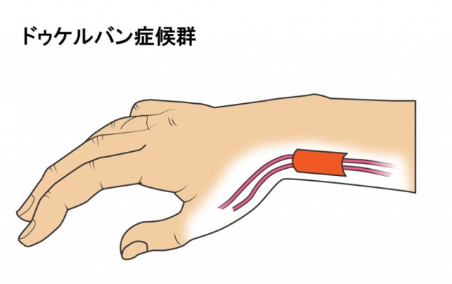 ドケルバン病ってどんな状態？