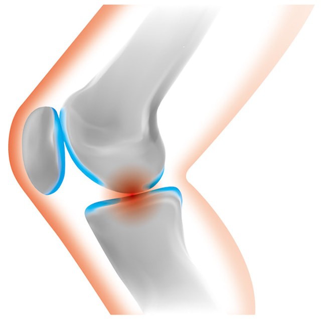 変形性膝関節症の原因とは？
