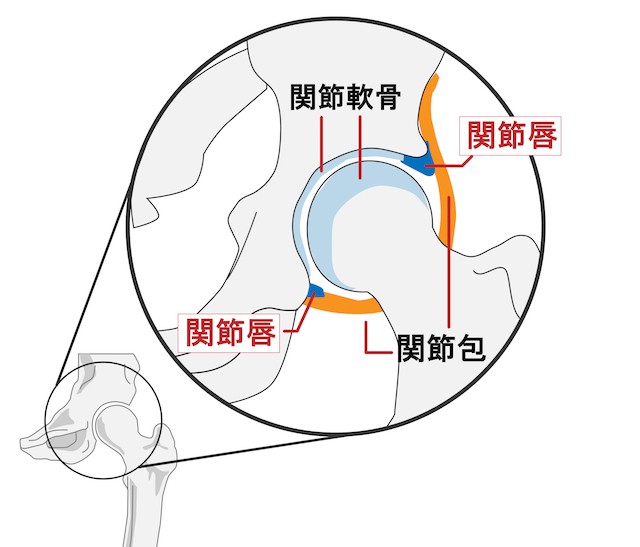 股関節　痛みの原因　臼蓋形成不全