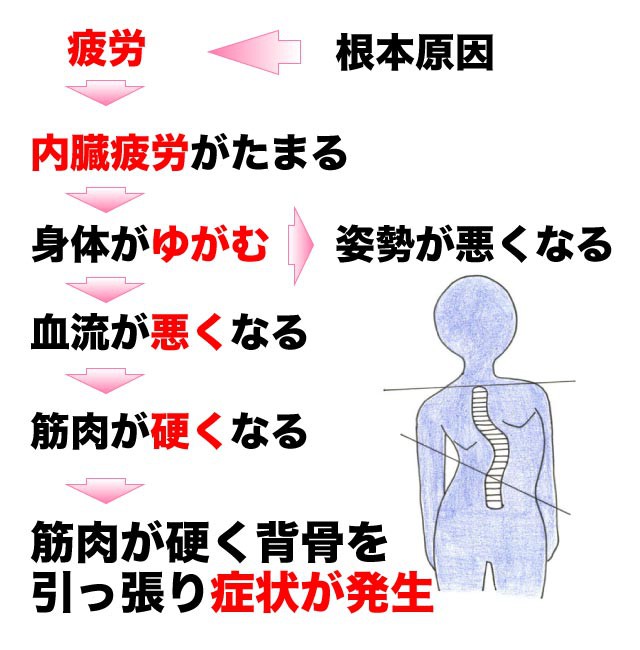 側湾症が起こるメカニズム